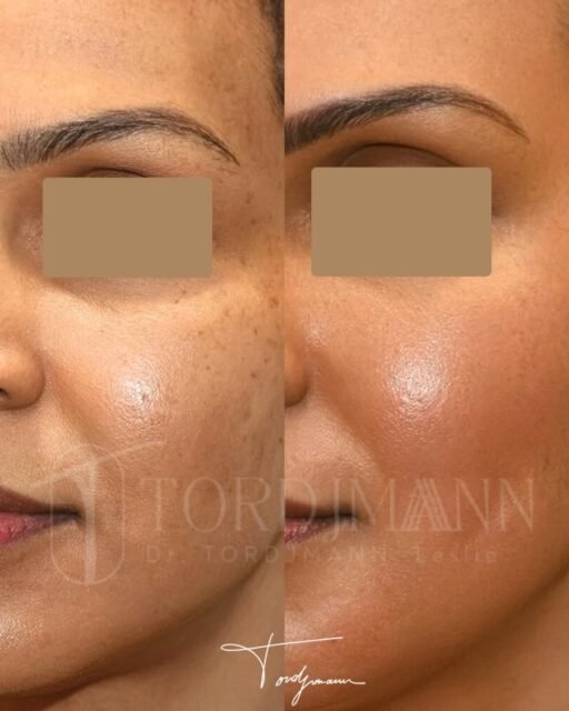 Améliorer l’éclat de la peau sans l’agresser, c’est possible avec un peeling médical bien conduit.
Le peeling BioRePeel est un peeling bi-phase conçu pour améliorer la qualité de peau, lisser le grain cutané et atténuer les irrégularités pigmentaires.
Il agit à la fois en surface et en profondeur grâce à une association d’acides, d’agents biostimulants et de composants hydratants.
Ce type de peeling est particulièrement recherché pour le teint terne, les taches, les pores visibles et les premiers signes de l’âge, tout en respectant la physiologie cutanée.
Il s’intègre dans une prise en charge progressive et contrôlée, adaptée à différents phototypes.
Ce visuel met en évidence une peau plus homogène, plus lumineuse et visiblement plus lisse, avec un rendu naturel et sans effet artificiel.
Un peeling médical bien choisi permet d’améliorer durablement la qualité de la peau tout en respectant son équilibre.
#peelingmedical
#biorepeel
#qualitedepeau
#teintlumineux
#medecineesthétique