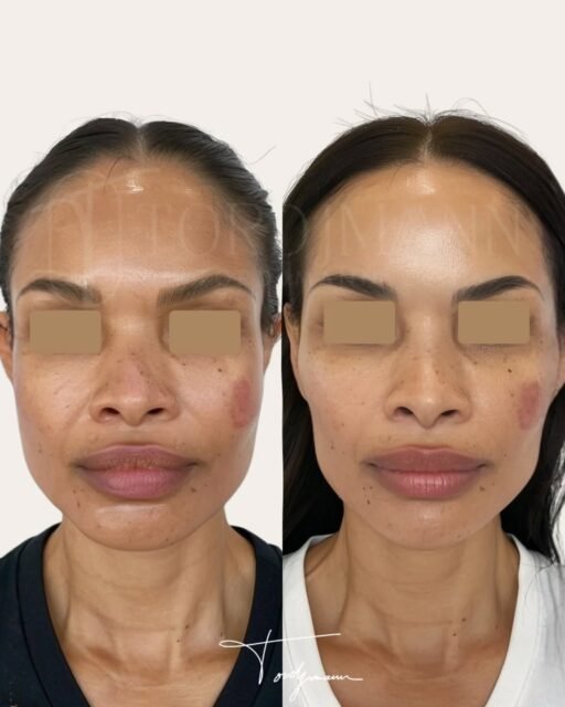 L’harmonisation faciale vise à rééquilibrer le visage sans le transformer.
L’harmonisation faciale par injections d’acide hyaluronique repose sur une analyse précise des volumes, des proportions et des axes du visage.
L’objectif n’est pas d’augmenter, mais de restaurer, soutenir et corriger certains déséquilibres liés à la morphologie ou au vieillissement.
Les injections peuvent concerner plusieurs zones du visage afin d’obtenir un résultat cohérent, progressif et respectueux des traits initiaux.
Cette approche globale mène à des résultats naturels et personnalisés.
Cet avant après illustre une amélioration de l’équilibre facial, avec des contours plus harmonieux, une meilleure répartition des volumes et un rendu subtil, sans excès.
L’harmonisation faciale par acide hyaluronique permet de révéler les traits du visage tout en préservant son identité.
#harmonisationfaciale
#acidehyaluronique
#injectionsvisage
#esthetiquemedicale
#résultatnaturel