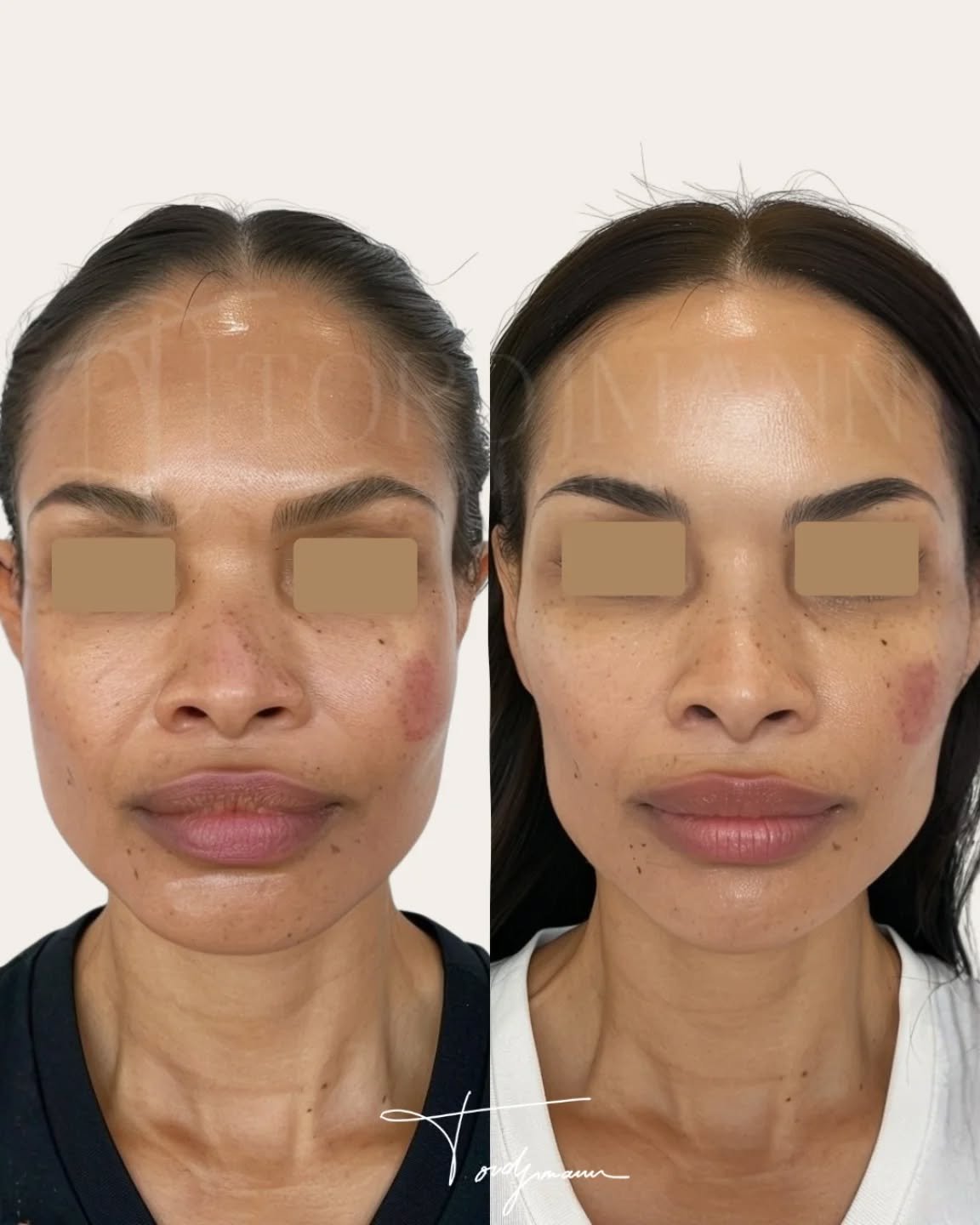 L’harmonisation faciale vise à rééquilibrer le visage sans le transformer.
L’harmonisation faciale par injections d’acide hyaluronique repose sur une analyse précise des volumes, des proportions et des axes du visage.
L’objectif n’est pas d’augmenter, mais de restaurer, soutenir et corriger certains déséquilibres liés à la morphologie ou au vieillissement.
Les injections peuvent concerner plusieurs zones du visage afin d’obtenir un résultat cohérent, progressif et respectueux des traits initiaux.
Cette approche globale mène à des résultats naturels et personnalisés.
Cet avant après illustre une amélioration de l’équilibre facial, avec des contours plus harmonieux, une meilleure répartition des volumes et un rendu subtil, sans excès.
L’harmonisation faciale par acide hyaluronique permet de révéler les traits du visage tout en préservant son identité.
#harmonisationfaciale
#acidehyaluronique
#injectionsvisage
#esthetiquemedicale
#résultatnaturel