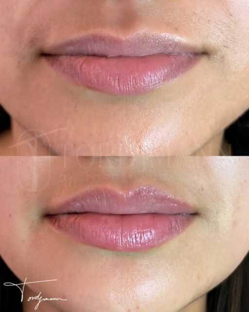 Des lèvres redessinées avec précision, sans effet artificiel.

Les injections d’acide hyaluronique des lèvres selon la Swedish Lip Technique visent à améliorer la définition, l’hydratation et l’équilibre des lèvres, sans sur-volume.
Cette technique privilégie le respect de l’anatomie labiale, en travaillant la structure et la projection de manière progressive.
L’utilisation de la canule permet une diffusion plus homogène du produit, avec un meilleur confort et une réduction du risque d’ecchymoses.
Ce type d’approche est particulièrement recherché pour un rendu naturel et élégant.

Ce visuel met en évidence des lèvres plus hydratées, mieux dessinées et subtilement repulpées, tout en conservant leur forme et leur expression naturelles.

La Swedish Lip Technique permet d’embellir les lèvres avec finesse, en préservant leur identité.

#acidehyaluroniquelèvres
#swedishlips
#injectionslevres
#esthétiquelèvres