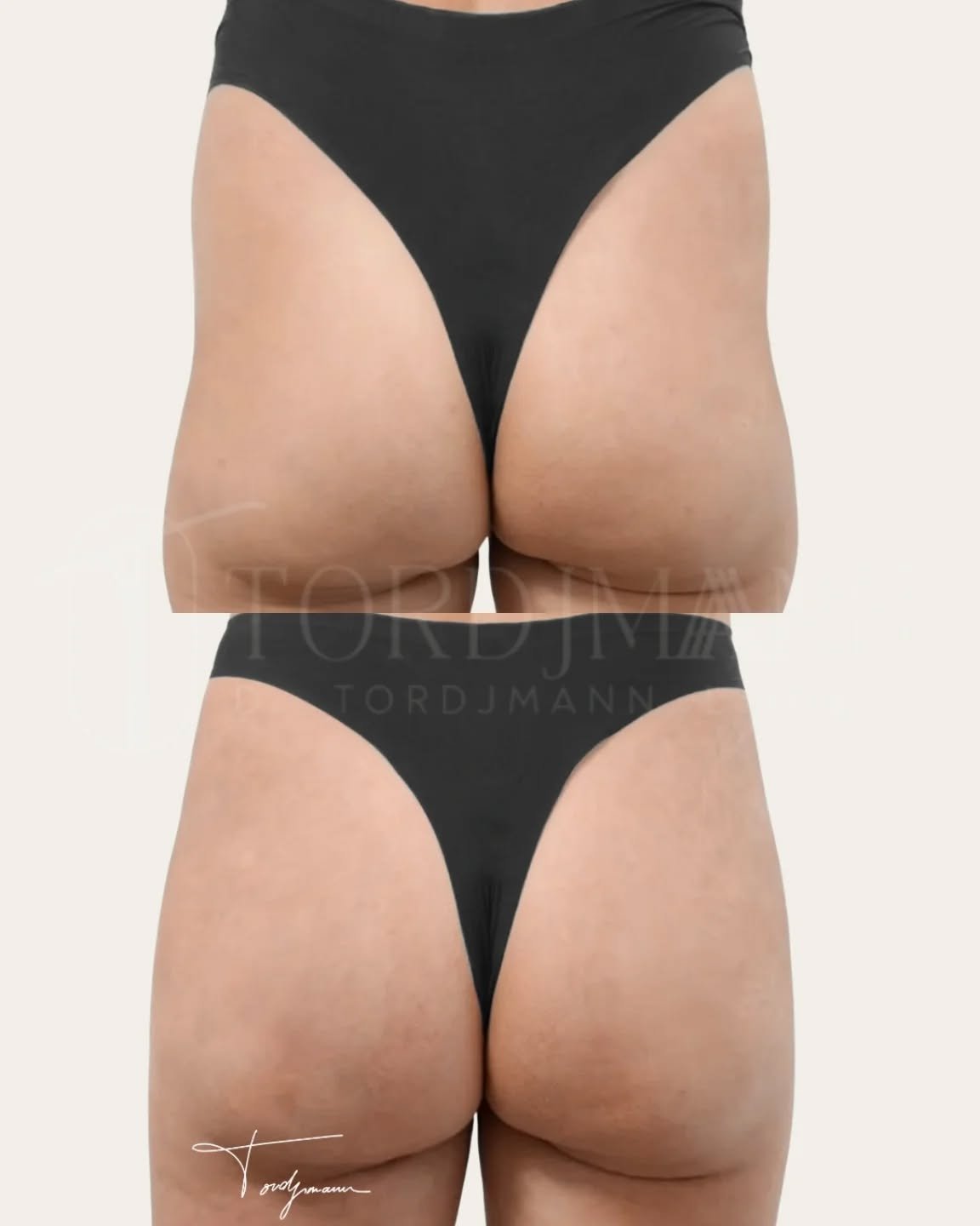 Redessiner les volumes corporels sans chirurgie, de façon progressive et naturelle.

Le traitement par Sculptra et acide hyaluronique au niveau des hanches permet de corriger des creux, d’harmoniser la silhouette et d’améliorer la continuité des volumes.
Le Sculptra agit comme un biostimulateur en relançant la production de collagène, avec un effet progressif et durable.
L’acide hyaluronique est ensuite utilisé de manière ciblée pour ajuster les volumes et affiner le résultat final.
Cette approche combinée est particulièrement indiquée lorsque l’objectif est une amélioration subtile, sans augmentation excessive.

Ce visuel met en évidence une silhouette plus équilibrée, avec des hanches mieux définies et un rendu homogène, respectueux de la morphologie initiale.

L’association Sculptra et acide hyaluronique permet une harmonisation corporelle progressive et naturelle.

#sculptra
#acidehyaluroniquefesses
#harmonisationcorporelle
#silhouette
#medecineesthetique