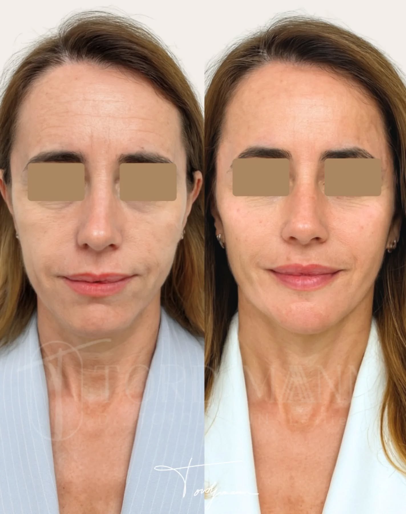 L’harmonisation faciale durable repose sur une stratégie, pas sur un seul traitement.

Cette prise en charge repose sur des traitements séquentiels, pensés dans le temps pour respecter la physiologie du visage.
Le Stimulate est utilisé en premier lieu pour stimuler la production de collagène et restaurer la structure profonde. Il permet ensuite d’améliorer la qualité de peau, la densité, le fripé et l’éclat.
Enfin, l’acide hyaluronique est utilisé de façon ciblée pour ajuster les volumes et finaliser l’harmonie globale du visage.

Cette approche progressive est particulièrement recherchée pour des résultats naturels et cohérents.

Ce visuel illustre une amélioration globale de la qualité de peau, des volumes et de l’équilibre facial, sans transformation des traits.

Les traitements séquentiels permettent d’obtenir un rajeunissement harmonieux, progressif et respectueux de l’identité du visage.

#harmonisationfaciale
#sculptra
#qualitedepeau
#stimulate
#medecineesthetique