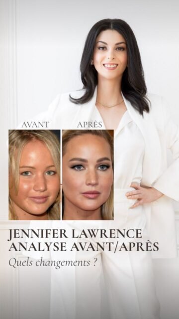 Quand une transformation est réussie, on reconnaît immédiatement la personne.
L’évolution du visage de Jennifer Lawrence illustre une transformation progressive et cohérente, sans rupture d’identité.
La perte de volume au niveau des joues s’inscrit dans une évolution naturelle liée au temps, parfois accentuée par des choix esthétiques comme la réduction des amas graisseux.
L’affinement du nez ne peut pas être obtenu par une rhinoplastie médicale, celle-ci permettant uniquement de corriger des asymétries ou des irrégularités, ce qui oriente plutôt vers une rhinoplastie chirurgicale.
Le bas du visage apparaît plus structuré, avec possiblement un travail du menton et un entretien régulier par toxine botulique pour préserver la qualité de peau et limiter les rides d’expression, notamment au niveau du regard, du front et parfois du cou.
Cette transformation montre qu’un travail esthétique bien mené vise à accompagner le vieillissement, à améliorer l’équilibre et la qualité de peau, sans jamais effacer les traits identitaires.
Une approche mesurée et globale permet de bonifier un visage avec le temps, sans le transformer.
#harmonisationfaciale
#medecineesthetique
#analysefaciale
#jenniferlawrence
#jenniferlawrencetransformation