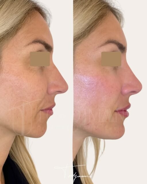 En profiloplastie, l’harmonie du profil dépend aussi des références anthropométriques propres à chaque origine ethnique.
La profiloplastie selon la méthode IDENTITY™ repose sur une analyse anthropométrique complète, intégrant les proportions du nez, du menton et des lèvres, mais aussi les normes liées à l’origine ethnique du visage.
Chez cette patiente d’origine européenne, les références anthropométriques montrent classiquement un nez avec un dorsum rectiligne ou légèrement concave, une pointe définie sans excès de projection et un équilibre précis avec le menton.
L’analyse a mis en évidence que le déséquilibre perçu ne provenait pas uniquement du nez, mais d’un déficit de soutien du menton modifiant la lecture globale du profil.
Une injection ciblée du menton a permis de restaurer la projection du tiers inférieur, tandis que le nez a été travaillé de façon mesurée pour lisser la ligne de profil sans créer une forme inadaptée à son origine.
Les lèvres ont été ajustées subtilement afin de respecter les rapports nez–lèvres attendus dans l’anthropométrie européenne et d’assurer une continuité harmonieuse du profil.
Ce résultat illustre une prise en charge guidée par les normes anthropométriques européennes, permettant d’obtenir un profil équilibré, cohérent et naturel, sans standardisation ni perte d’identité.
La méthode IDENTITY™ applique l’anthropométrie ethnique pour adapter chaque geste d’injection au visage traité, et non l’inverse.
Disclaimer :
Ces images illustrent le résultat obtenu chez un patient précis, dans un contexte anatomique et ethnique donné.
Ce résultat ne garantit en aucun cas l’obtention d’un résultat identique chez d’autres patients. Chaque prise en charge est individualisée et dépend de l’anatomie, de l’origine ethnique, des indications médicales et de la réponse propre à chacun.
#profiloplastie
#anthropometriefaciale
#harmonisationfaciale
#methodeidentity
#medecineesthetique