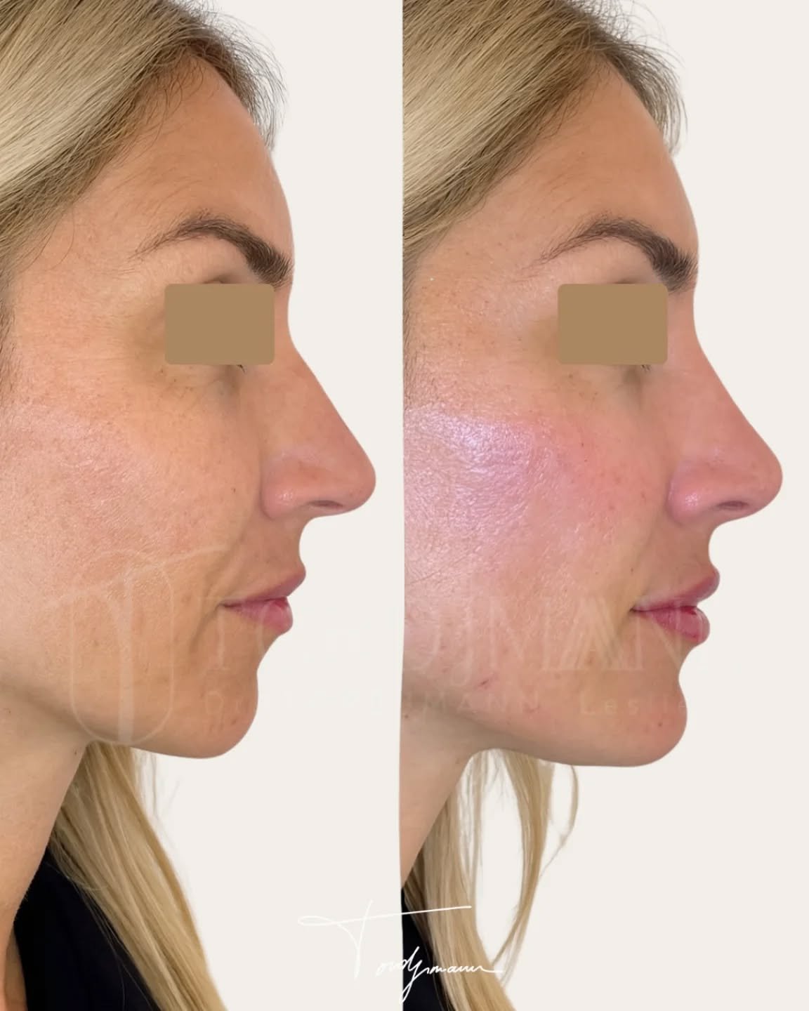 En profiloplastie, l’harmonie du profil dépend aussi des références anthropométriques propres à chaque origine ethnique.
La profiloplastie selon la méthode IDENTITY™ repose sur une analyse anthropométrique complète, intégrant les proportions du nez, du menton et des lèvres, mais aussi les normes liées à l’origine ethnique du visage.
Chez cette patiente d’origine européenne, les références anthropométriques montrent classiquement un nez avec un dorsum rectiligne ou légèrement concave, une pointe définie sans excès de projection et un équilibre précis avec le menton.
L’analyse a mis en évidence que le déséquilibre perçu ne provenait pas uniquement du nez, mais d’un déficit de soutien du menton modifiant la lecture globale du profil.
Une injection ciblée du menton a permis de restaurer la projection du tiers inférieur, tandis que le nez a été travaillé de façon mesurée pour lisser la ligne de profil sans créer une forme inadaptée à son origine.
Les lèvres ont été ajustées subtilement afin de respecter les rapports nez–lèvres attendus dans l’anthropométrie européenne et d’assurer une continuité harmonieuse du profil.
Ce résultat illustre une prise en charge guidée par les normes anthropométriques européennes, permettant d’obtenir un profil équilibré, cohérent et naturel, sans standardisation ni perte d’identité.
La méthode IDENTITY™ applique l’anthropométrie ethnique pour adapter chaque geste d’injection au visage traité, et non l’inverse.
Disclaimer :
Ces images illustrent le résultat obtenu chez un patient précis, dans un contexte anatomique et ethnique donné.
Ce résultat ne garantit en aucun cas l’obtention d’un résultat identique chez d’autres patients. Chaque prise en charge est individualisée et dépend de l’anatomie, de l’origine ethnique, des indications médicales et de la réponse propre à chacun.
#profiloplastie
#anthropometriefaciale
#harmonisationfaciale
#methodeidentity
#medecineesthetique