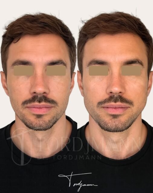 La masculinisation faciale ne consiste pas à durcir un visage, mais à renforcer ses marqueurs masculins naturels.

La masculinisation selon la méthode IDENTITY™ repose sur une analyse anthropométrique précise du visage masculin.
Elle prend en compte les proportions spécifiques de l’homme, notamment la largeur et la projection mandibulaire, la structure du menton, la définition des angles et l’équilibre du tiers moyen.
Les injections d’acide hyaluronique sont utilisées ici de façon ciblée et structurelle, afin de renforcer les lignes masculines sans modifier l’identité du visage.
Chaque choix d’injection est guidé par les normes anthropométriques masculines et par l’origine morphologique du patient, évitant toute standardisation ou excès.

Ce résultat illustre un visage plus structuré, avec une meilleure définition des contours et une lecture plus masculine, tout en conservant des traits naturels et reconnaissables.

La méthode IDENTITY™ permet une masculinisation faciale cohérente, mesurée et respectueuse de l’identité individuelle.

Disclaimer 
Ces images présentent le résultat obtenu chez un patient précis, dans un contexte anatomique donné.
Ce résultat ne garantit en aucun cas l’obtention d’un résultat identique chez d’autres patients. Chaque prise en charge est personnalisée et dépend de l’anatomie, des indications médicales et de la réponse individuelle au traitement.

#masculinisationfaciale
#harmonisationfaciale
#anthropometriefaciale
#methodeidentity 
#medecineesthetique