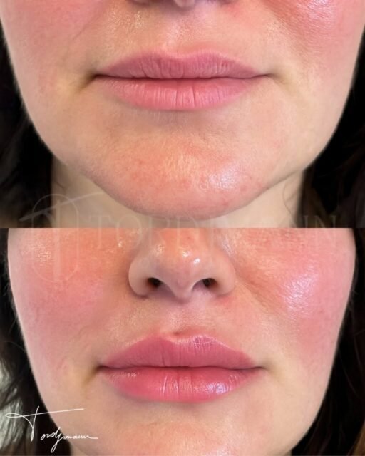 Des lèvres harmonisées sans standardisation, guidées par l’anatomie et les proportions.
Le traitement des lèvres selon la méthode IDENTITY™ que j’ai développé repose sur une analyse anthropométrique précise du bas du visage.
Cette approche prend en compte la relation lèvres–nez–menton, l’épaisseur cutanée, la dynamique labiale et les références propres à l’identité du visage.
L’acide hyaluronique est utilisé ici de façon mesurée, non pour créer du volume systématique, mais pour restaurer l’équilibre, la définition et l’hydratation.
Chaque point d’injection, chaque quantité et chaque profondeur sont choisis en fonction de la morphologie et non d’un modèle esthétique unique.
Le résultat illustré montre des lèvres plus définies, mieux hydratées et équilibrées, avec un rendu naturel respectant l’expression et l’identité du visage.
La méthode IDENTITY™ applique l’anthropométrie faciale pour sublimer les lèvres sans les transformer.
Disclaimer – résultat illustré
Ces images présentent le résultat obtenu chez un patient précis, dans un contexte anatomique donné.
Ce résultat ne garantit en aucun cas l’obtention d’un résultat identique chez d’autres patients. Chaque prise en charge est personnalisée et dépend de l’anatomie, des indications et de la réponse individuelle au traitement.
#acidehyaluroniquelèvres
#methodeidentity
#anthropometriefaciale
#injectionslèvres
#medecineesthetique