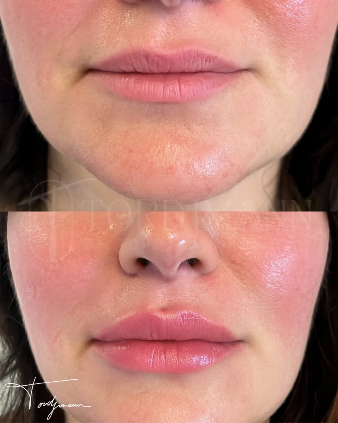 Des lèvres harmonisées sans standardisation, guidées par l’anatomie et les proportions.
Le traitement des lèvres selon la méthode IDENTITY™ que j’ai développé repose sur une analyse anthropométrique précise du bas du visage.
Cette approche prend en compte la relation lèvres–nez–menton, l’épaisseur cutanée, la dynamique labiale et les références propres à l’identité du visage.
L’acide hyaluronique est utilisé ici de façon mesurée, non pour créer du volume systématique, mais pour restaurer l’équilibre, la définition et l’hydratation.
Chaque point d’injection, chaque quantité et chaque profondeur sont choisis en fonction de la morphologie et non d’un modèle esthétique unique.
Le résultat illustré montre des lèvres plus définies, mieux hydratées et équilibrées, avec un rendu naturel respectant l’expression et l’identité du visage.
La méthode IDENTITY™ applique l’anthropométrie faciale pour sublimer les lèvres sans les transformer.
Disclaimer – résultat illustré
Ces images présentent le résultat obtenu chez un patient précis, dans un contexte anatomique donné.
Ce résultat ne garantit en aucun cas l’obtention d’un résultat identique chez d’autres patients. Chaque prise en charge est personnalisée et dépend de l’anatomie, des indications et de la réponse individuelle au traitement.
#acidehyaluroniquelèvres
#methodeidentity
#anthropometriefaciale
#injectionslèvres
#medecineesthetique