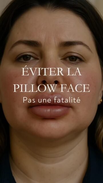 L’effet « pillow face » n’est pas une fatalité lorsqu’on comprend comment et où injecter.
L’aspect « pillow face » après injections d’acide hyaluronique est le plus souvent lié à un excès de produit ou à des injections trop superficielles.
L’acide hyaluronique est une substance hydrophile, capable d’attirer l’eau, ce qui impose une grande maîtrise des volumes injectés.
Le respect des plans profonds d’injection permet de soutenir les structures sans alourdir les traits ni modifier l’expression du visage.
Dans certaines zones, notamment périphériques, les biostimulateurs comme le Sculptra peuvent constituer une alternative intéressante en stimulant la production naturelle de collagène sans effet volumateur direct.
En revanche, certaines régions comme le mid-face nécessitent spécifiquement l’utilisation d’acide hyaluronique pour un soutien structurel adapté.
Ce contenu explique les mécanismes réels de l’effet « pillow face » et met en lumière l’importance du choix du produit, de la profondeur et de la stratégie d’injection.
Éviter l’effet « pillow face » repose sur une approche raisonnée, anatomique et personnalisée des injections.
#acidehyaluronique
#pillowface
#injectionsvisage
#harmonisationfaciale
#medecineesthetique