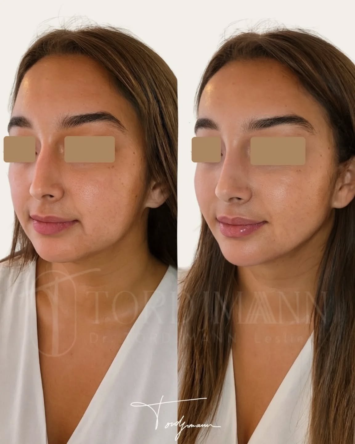 L’harmonisation faciale ne consiste pas à transformer un visage, mais à rééquilibrer ses proportions.

Cette prise en charge a été réalisée selon la méthode IDENTITY™, qui repose sur une analyse anthropométrique complète du visage.
Les injections d’acide hyaluronique sont guidées par l’étude des proportions entre les différents tiers du visage, la projection des volumes et les lignes de force naturelles.
L’objectif n’est pas d’augmenter systématiquement certaines zones, mais de restaurer l’équilibre structurel et la continuité des volumes.
Chaque geste est déterminé en fonction de l’anatomie, de l’origine morphologique du visage et de l’expression naturelle du patient.

Le visage est plus harmonieux, avec une meilleure transition des volumes et une qualité de peau plus lumineuse, tout en conservant des traits naturels et reconnaissables.

La méthode IDENTITY™ permet une harmonisation faciale personnalisée, fondée sur l’anthropométrie et le respect de l’identité du visage.

Disclaimer
Ces images présentent le résultat obtenu chez une patiente précise, dans un contexte anatomique donné.
Ce résultat ne garantit en aucun cas l’obtention d’un résultat identique chez d’autres patients. Chaque prise en charge est personnalisée et dépend de l’anatomie, des indications médicales et de la réponse individuelle au traitement.

#harmonisationfaciale
#methodeidentity
#anthropometriefaciale
#analysefaciale
#medecineesthetique