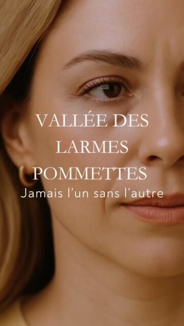 Toutes les cernes ne doivent pas être injectées directement.

Un test très simple peut vous donner un indice.

Appuyez légèrement au niveau de la pommette, juste sous l’œil.
Si votre cerne remonte ou s’améliore, cela signifie souvent que le problème vient d’un manque de soutien du tiers moyen du visage.

Avec le temps, la graisse et les structures de soutien de la pommette diminuent.
La zone se creuse et la vallée des larmes devient plus visible, donnant l’impression d’un cerne marqué.

Dans ce cas, la solution n’est pas toujours d’injecter dans le cerne.

Il peut être plus pertinent de traiter :
• la pommette
• la vallée des larmes

Cela permet de restaurer le soutien du visage, d’améliorer la transition paupière-joue et parfois de corriger le cerne sans injecter directement dans cette zone, qui est plus délicate.

En médecine esthétique, la zone visible n’est pas toujours la zone à traiter.

⚠️ Les indications et résultats varient selon l’anatomie de chaque patient. Une consultation médicale est nécessaire pour déterminer la stratégie la plus adaptée.

#cerne #valleedeslarmes #pommettes #acidehyaluronique #medecineesthetique