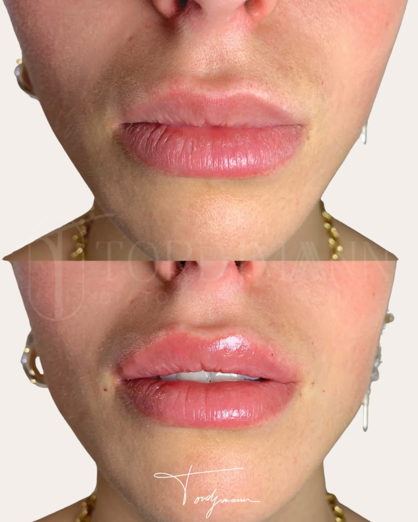 L’objectif d’une injection des lèvres n’est pas d’augmenter, mais d’harmoniser.
Les injections d’acide hyaluronique des lèvres permettent d’améliorer la définition du contour, l’hydratation et l’équilibre des volumes.
L’approche consiste à respecter l’anatomie naturelle des lèvres, leur proportion avec le nez et le menton ainsi que la dynamique du sourire.
Le produit est injecté de manière mesurée afin d’obtenir une projection subtile, sans excès ni modification artificielle des traits.
Cette stratégie vise à restaurer l’harmonie du bas du visage tout en conservant l’identité du sourire.
Une injection bien indiquée et bien dosée permet d’embellir les lèvres sans les transformer.
Disclaimer – résultat illustré
Ces images illustrent le résultat obtenu chez une patiente précise, dans un contexte anatomique donné.
Ce résultat ne garantit en aucun cas l’obtention d’un résultat identique chez d’autres patientes. Chaque prise en charge est personnalisée et dépend de l’anatomie, des indications médicales et de la réponse individuelle au traitement.
#acidehyaluroniquelèvres
#injectionslèvres
#medecineesthetique