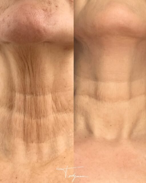 Le cou est souvent l’une des premières zones à trahir la perte de collagène.

Avec le temps, la peau du cou devient plus fine, plus relâchée et les rides verticales commencent à apparaître.
Cette zone est particulièrement fragile car elle contient peu de glandes sébacées et subit une forte perte de collagène et d’élastine avec l’âge.

Dans ce cas, l’objectif n’est pas de remplir, mais de stimuler la peau.
Les biostimulateurs permettent de relancer la production naturelle de collagène dans le derme.
Progressivement, la peau devient plus dense, plus tonique et les rides du cou s’atténuent.
Ce type de traitement agit directement sur la qualité de la peau, avec une amélioration progressive de la texture et de la fermeté cutanée.

⚠️ Disclaimer
Chaque patient est différent. Les résultats peuvent varier selon la qualité de peau, l’âge et les caractéristiques individuelles. Une consultation médicale est nécessaire pour déterminer la prise en charge la plus adaptée.

#cou
#biostimulateur
#relachementcutane
#collagene
#medecineesthetique