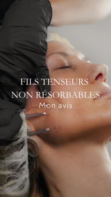 Les fils tenseurs non résorbables ne font pas l’unanimité en médecine esthétique.

Les fils tenseurs non résorbables sont des fils placés sous la peau afin de tracter les tissus et maintenir un effet lifting.
Contrairement aux fils résorbables, ils ne se dissolvent pas et restent de façon permanente dans les tissus sous-cutanés.
Certains praticiens utilisent cette technique et en sont satisfaits, mais elle soulève une question importante : le visage continue à vieillir autour d’un dispositif qui reste en place.
Avec le temps, la descente des tissus et l’évolution naturelle du visage peuvent modifier l’équilibre obtenu initialement.

En médecine esthétique, le choix d’une technique repose aussi sur la manière dont elle s’intègre dans l’évolution naturelle du visage.

#filstenseurs
#liftingmedical
#harmonisationfaciale
#medecineesthetique
#analysefaciale