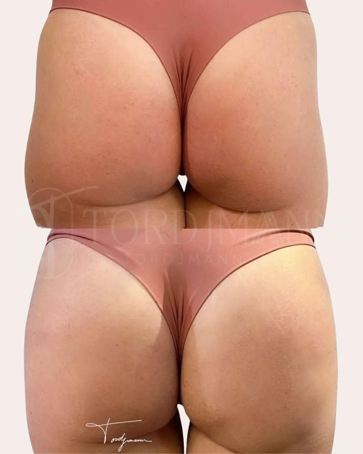 Remodeler les fesses sans chirurgie, c’est possible.
L’augmentation des fesses par injections d’acide hyaluronique permet de redessiner les volumes et d’améliorer la projection sans implants ni lipofilling.
L’objectif n’est pas seulement d’augmenter le volume.
Le travail consiste surtout à restructurer les courbes naturelles :
• améliorer la projection
• redéfinir le galbe latéral
• harmoniser la transition hanches-fesses
• corriger certaines asymétries.
L’acide hyaluronique utilisé pour cette zone est spécifique au body contouring.
Il est injecté en profondeur afin d’obtenir un résultat naturel, progressif et harmonieux.
Ce traitement peut être une alternative intéressante pour les patients qui souhaitent :
• un remodelage des fesses sans chirurgie
• éviter les implants ou le lipofilling
• obtenir un résultat immédiat avec peu d’éviction sociale.
⚠️ Les résultats et indications varient selon l’anatomie et la qualité des tissus de chaque patient. Une consultation médicale est nécessaire pour déterminer la prise en charge adaptée.
#remodelagefessier
#fesses
#acidehyaluronique
#augmentationfesses
#medecineesthetique