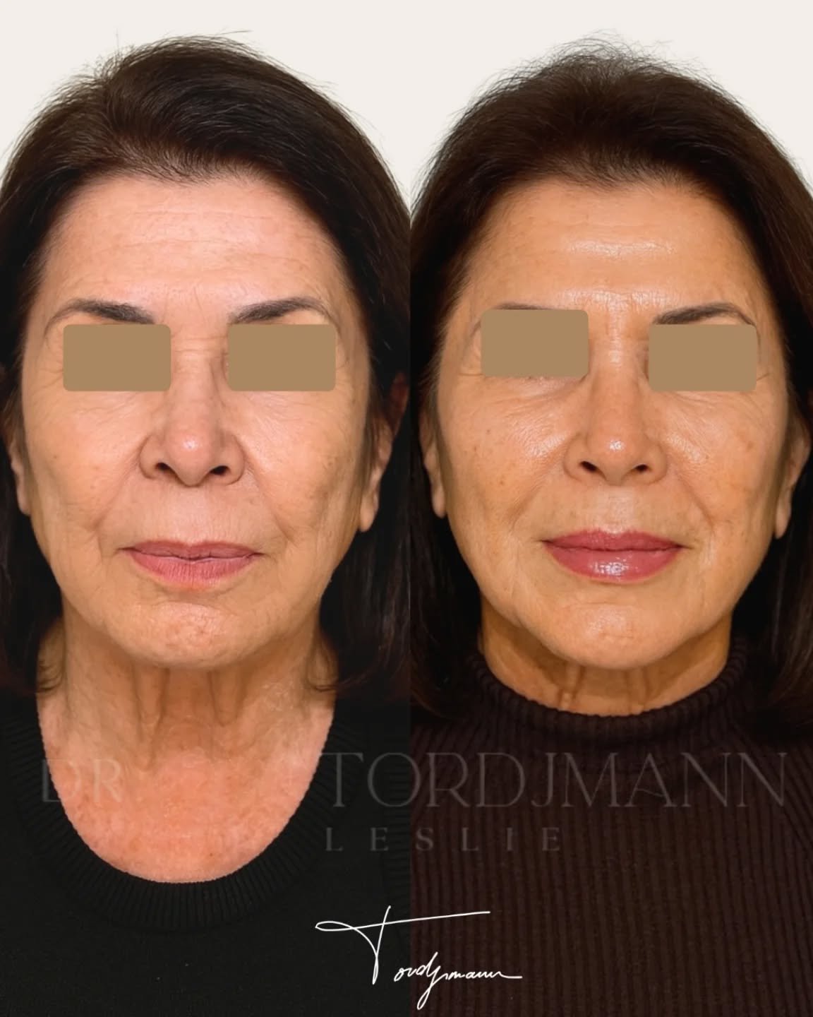 Le rajeunissement du visage repose souvent sur une combinaison de traitements plutôt que sur une seule technique.

Cette prise en charge a été réalisée selon la méthode IDENTITY™, fondée sur une analyse anthropométrique précise des volumes et des proportions du visage.

La stratégie a associé des stimulateurs cutanés type Stimulate et Hydrodeluxe pour améliorer la qualité de peau et relancer la production de collagène, ainsi que des injections d’acide hyaluronique pour restaurer certains volumes et soutenir les structures faciales.

Cette approche séquentielle permet d’agir à la fois sur la structure du visage et sur la densité cutanée, deux éléments essentiels du vieillissement facial.
Les zones traitées et les volumes injectés sont déterminés en fonction de l’anatomie, de la dynamique du visage et de l’équilibre global recherché.

Ce résultat illustre une amélioration globale du visage, avec des volumes plus harmonieux, une peau plus dense et un rendu naturel respectant les traits et l’expression.

La méthode IDENTITY™ combine analyse anthropométrique et traitements complémentaires pour obtenir un rajeunissement cohérent et personnalisé.

Disclaimer
Ces images présentent le résultat obtenu chez une patiente précise, dans un contexte anatomique donné.
Ce résultat ne garantit en aucun cas l’obtention d’un résultat identique chez d’autres patients. Chaque prise en charge est personnalisée et dépend de l’anatomie, des indications médicales et de la réponse individuelle au traitement.

#harmonisationfaciale
#methodeidentity
#biostimulation
#anthropometriefaciale
#medecineesthetique