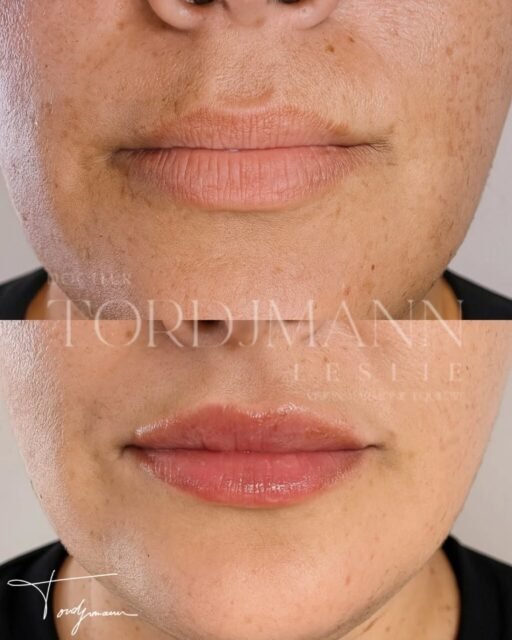 Hydrater les lèvres sans les augmenter, c’est possible.

Les skinboosters lèvres reposent sur l’injection d’acide hyaluronique non volumateur, spécifiquement conçu pour améliorer la qualité de peau.
Contrairement aux injections classiques, l’objectif n’est pas de modifier le volume mais de réhydrater en profondeur, lisser les ridules et restaurer la souplesse des lèvres.
Ce traitement agit directement sur la texture, la luminosité et la déshydratation labiale, souvent responsables d’un aspect terne ou fripé.

Disclaimer – résultat illustré
Ces images présentent le résultat obtenu chez une patiente spécifique.
Ce résultat ne garantit pas un résultat identique chez d’autres patients, chaque indication dépend de l’anatomie, de la qualité de peau et des besoins individuels.

#skinbooster
#levres
#acidehyaluronique
#hydratationlevres
#medecineesthetique