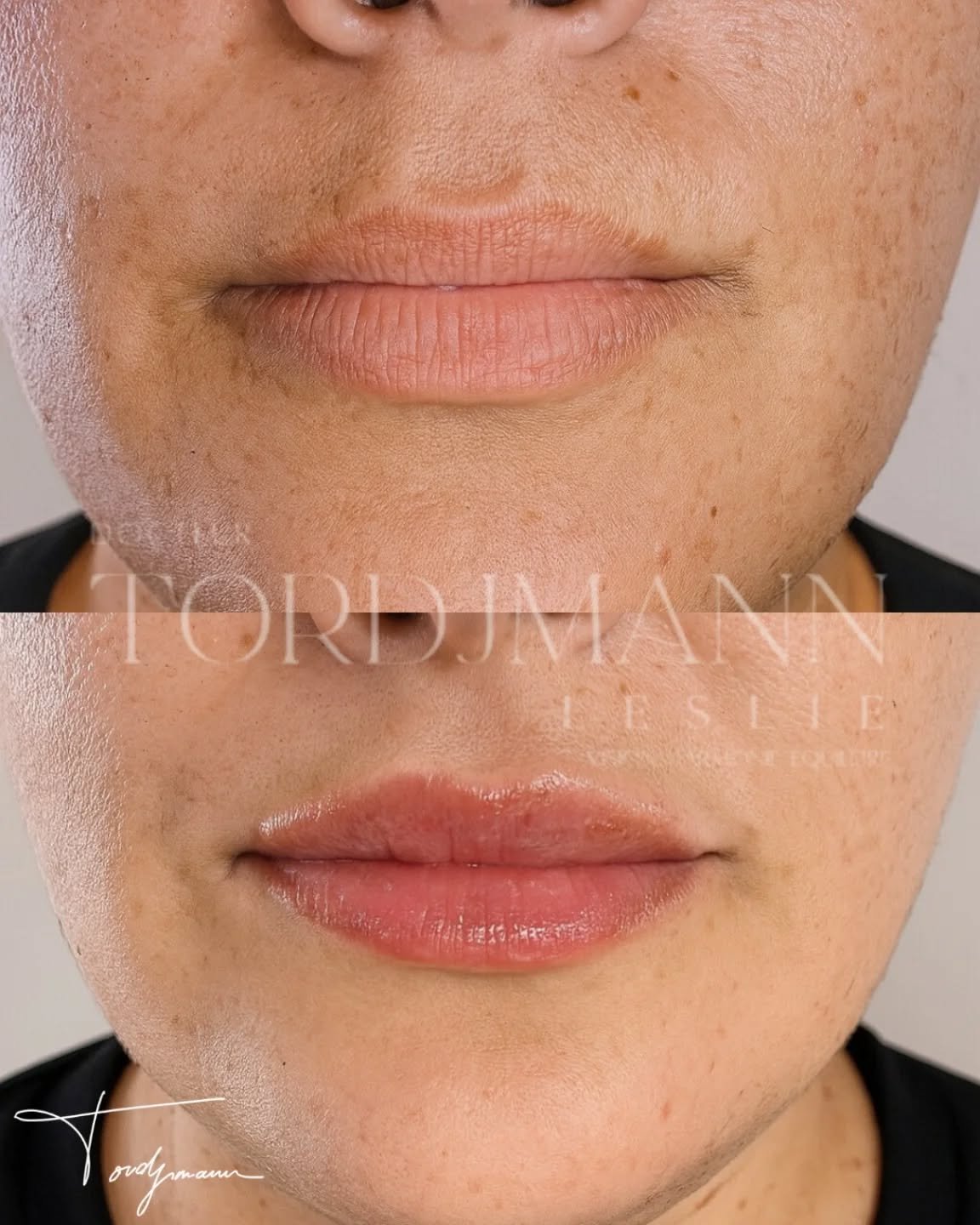 Hydrater les lèvres sans les augmenter, c’est possible.

Les skinboosters lèvres reposent sur l’injection d’acide hyaluronique non volumateur, spécifiquement conçu pour améliorer la qualité de peau.
Contrairement aux injections classiques, l’objectif n’est pas de modifier le volume mais de réhydrater en profondeur, lisser les ridules et restaurer la souplesse des lèvres.
Ce traitement agit directement sur la texture, la luminosité et la déshydratation labiale, souvent responsables d’un aspect terne ou fripé.

Disclaimer – résultat illustré
Ces images présentent le résultat obtenu chez une patiente spécifique.
Ce résultat ne garantit pas un résultat identique chez d’autres patients, chaque indication dépend de l’anatomie, de la qualité de peau et des besoins individuels.

#skinbooster
#levres
#acidehyaluronique
#hydratationlevres
#medecineesthetique