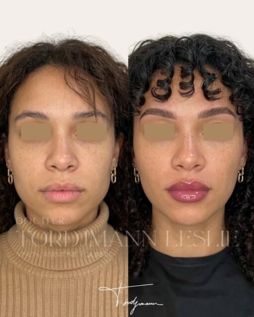 L’harmonisation faciale ne suit pas un modèle universel, elle s’adapte à chaque identité.
Cette prise en charge a été réalisée selon la méthode IDENTITY™, basée sur une analyse anthropométrique intégrant les variations ethniques du visage.
Les proportions, les volumes et les lignes faciales diffèrent selon l’origine, ce qui implique une stratégie d’injection entièrement personnalisée.
De l’acide hyaluronique et du Stimulate ont été utilisés ici pour restaurer l’équilibre du visage en respectant les références propres à cette morphologie, sans chercher à standardiser les traits.
Le travail porte sur les zones clés du visage afin d’améliorer la structure globale tout en conservant les caractéristiques identitaires.
Ce résultat illustre une harmonisation subtile, où les volumes sont rééquilibrés et la qualité de peau améliorée, tout en respectant les spécificités ethniques du visage.
La méthode IDENTITY™ permet d’adapter chaque injection à l’anthropométrie individuelle pour un résultat naturel et cohérent.
Disclaimer : Ces images présentent le résultat obtenu chez une patiente précise, dans un contexte anatomique et ethnique donné. Ce résultat ne garantit en aucun cas l’obtention d’un résultat identique chez d’autres patients. Chaque prise en charge est personnalisée et dépend de l’anatomie, des indications médicales et de la réponse individuelle au traitement.
#harmonisationfaciale
#methodeidentity
#acidehyaluronique
#beautenaturelle
#medecineesthetique