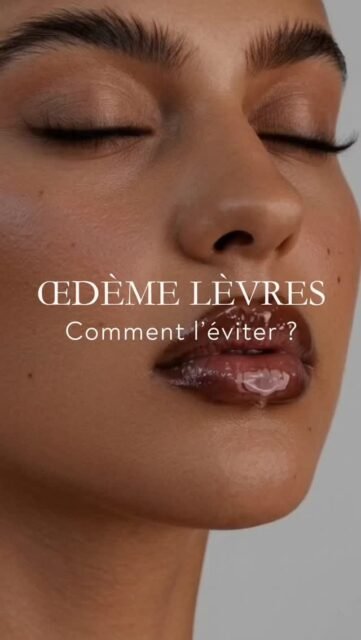 Après des injections des lèvres, certaines erreurs augmentent le gonflement.

Les injections d’acide hyaluronique lèvres entraînent toujours un léger œdème, mais certains facteurs peuvent l’aggraver.
La chaleur est le principal élément à éviter :
• sport dans les 48–72h
• exposition à une forte température
• consommation d’alcool (effet vasodilatateur).
Ces éléments augmentent le flux sanguin et favorisent un gonflement plus important et prolongé.
À l’inverse, le froid aide à limiter l’inflammation et à améliorer le confort post-injection.

Comprendre ces mécanismes permet de mieux gérer l’après-injection et d’optimiser le résultat dès les premiers jours.

Moins de chaleur, plus de froid : c’est la clé pour limiter l’œdème après des injections des lèvres.

#acidehyaluronique
#levres
#postinjection
#medecineesthetique
#soinsesthetiques