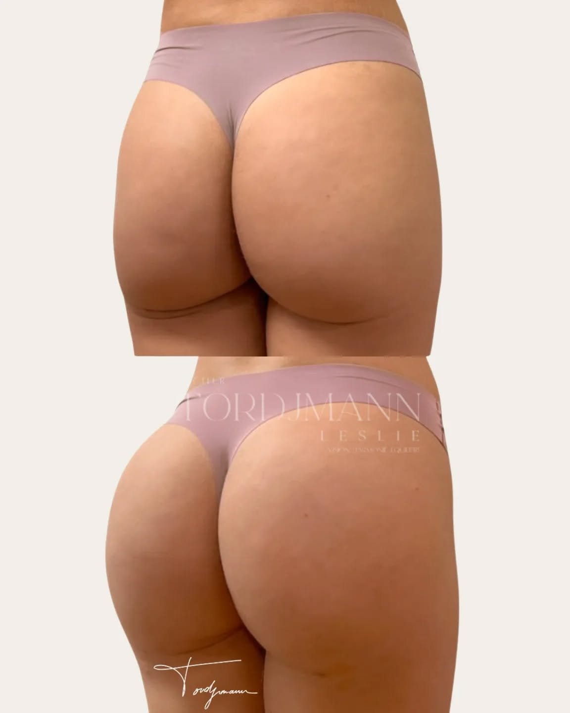 Augmenter les fesses sans chirurgie, tout en restant naturel.

Les injections d’acide hyaluronique fesses permettent un remodelage fessier sans chirurgie, sans implants ni lipofilling.
L’objectif n’est pas uniquement d’augmenter le volume, mais de redessiner les proportions, améliorer la projection et harmoniser la silhouette.
Le produit est injecté en profondeur pour respecter l’anatomie et obtenir un résultat progressif et équilibré, adapté à chaque morphologie.

Ce résultat montre une amélioration du galbe et de la projection, avec une transition plus harmonieuse entre les hanches et les fesses, sans effet artificiel.

Le remodelage fessier par acide hyaluronique permet d’obtenir du volume et une meilleure harmonie corporelle sans chirurgie.

Disclaimer – résultat illustré
Ces images présentent le résultat obtenu chez une patiente spécifique.
Ce résultat ne garantit pas un résultat identique chez d’autres patients, chaque indication dépend de l’anatomie, de la qualité des tissus et des objectifs.

#remodelagefessier
#acidehyaluronique
#augmentationfesses
#bodycontouring
#medecineesthetique