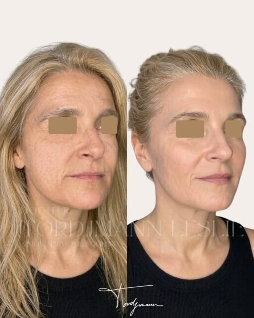 Rajeunir un visage, ce n’est pas ajouter du volume, c’est restaurer l’équilibre.

Cette harmonisation faciale a été réalisée selon la méthode IDENTITY™, avec une approche globale combinant plusieurs techniques.
Les biostimulateurs (Stimulate) ont permis de relancer la production de collagène et de retendre les tissus.
Les skinboosters (Hydrodeluxe) ont amélioré la qualité de peau, l’hydratation et l’éclat.
Les injections d’acide hyaluronique ont été utilisées de manière ciblée pour restaurer les volumes stratégiques.
Enfin, un peeling TCA a permis d’unifier le teint et d’améliorer la texture cutanée.

Le résultat repose sur une stratégie séquentielle et personnalisée, qui agit à la fois sur la structure, la qualité de peau et la luminosité, sans transformation artificielle.

Une approche combinée permet un rajeunissement naturel en respectant l’identité du visage.

Disclaimer – résultat illustré
Ces images présentent le résultat obtenu chez une patiente spécifique.
Ce résultat ne garantit pas un résultat identique chez d’autres patients, chaque prise en charge dépend de l’anatomie, de la qualité de peau et des indications.

#harmonisationfaciale
#biostimulateurs
#acidehyaluronique
#skinbooster
#methodeidentity