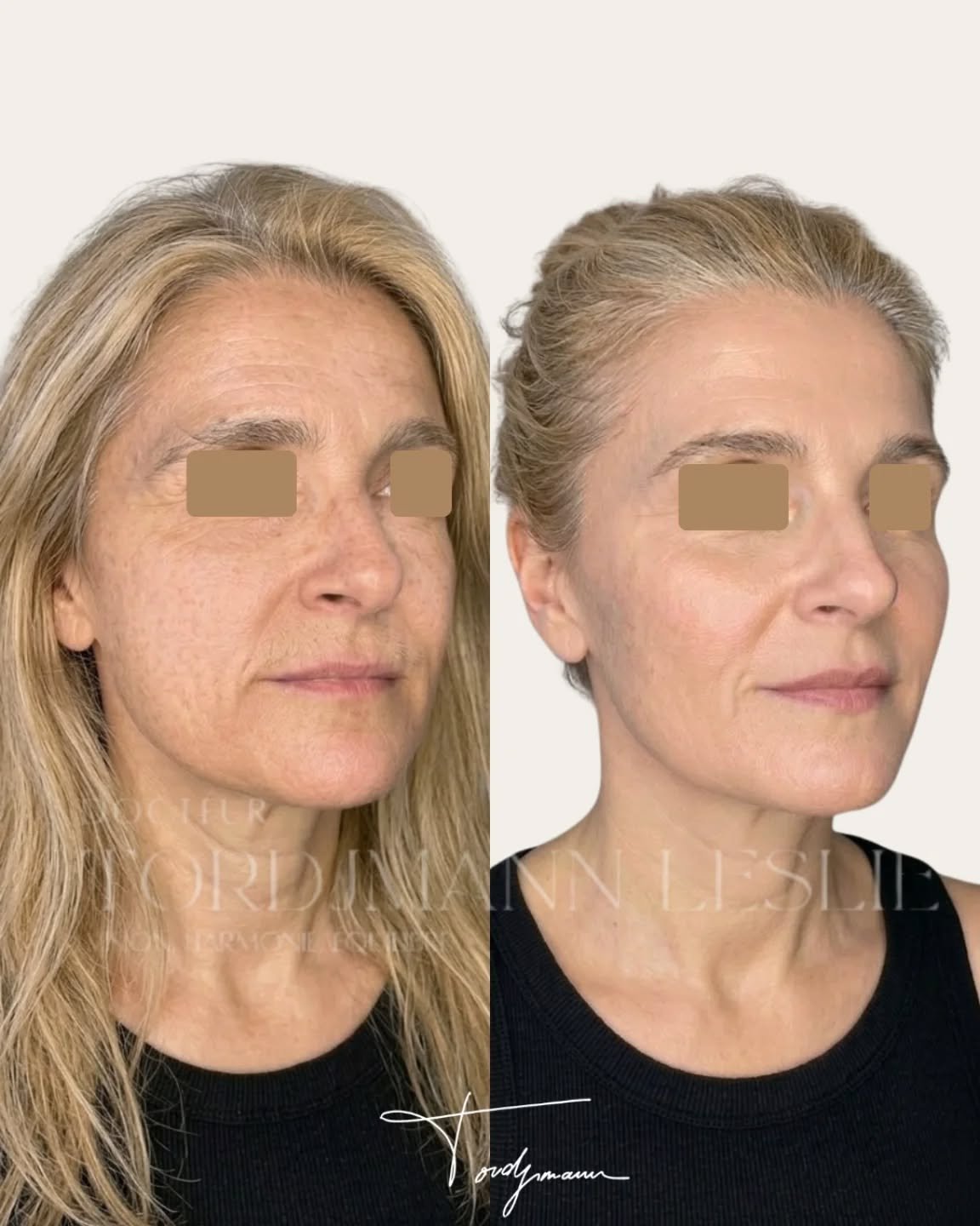 Rajeunir un visage, ce n’est pas ajouter du volume, c’est restaurer l’équilibre.

Cette harmonisation faciale a été réalisée selon la méthode IDENTITY™, avec une approche globale combinant plusieurs techniques.
Les biostimulateurs (Stimulate) ont permis de relancer la production de collagène et de retendre les tissus.
Les skinboosters (Hydrodeluxe) ont amélioré la qualité de peau, l’hydratation et l’éclat.
Les injections d’acide hyaluronique ont été utilisées de manière ciblée pour restaurer les volumes stratégiques.
Enfin, un peeling TCA a permis d’unifier le teint et d’améliorer la texture cutanée.

Le résultat repose sur une stratégie séquentielle et personnalisée, qui agit à la fois sur la structure, la qualité de peau et la luminosité, sans transformation artificielle.

Une approche combinée permet un rajeunissement naturel en respectant l’identité du visage.

Disclaimer – résultat illustré
Ces images présentent le résultat obtenu chez une patiente spécifique.
Ce résultat ne garantit pas un résultat identique chez d’autres patients, chaque prise en charge dépend de l’anatomie, de la qualité de peau et des indications.

#harmonisationfaciale
#biostimulateurs
#acidehyaluronique
#skinbooster
#methodeidentity