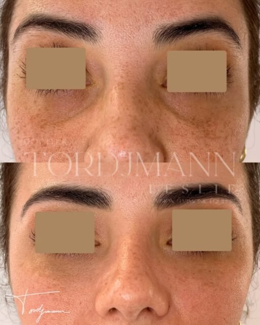 Traiter les cernes, ce n’est pas seulement combler un creux.
Les cernes creux sont souvent liés à une perte de soutien au niveau de la vallée des larmes et de la zone malaire.
Les injections d’acide hyaluronique des cernes permettent de restaurer ce soutien en profondeur, à condition de respecter l’anatomie et les indications.
Le produit est injecté de manière précise pour lisser la transition entre la paupière et la joue, sans alourdir le regard ni créer d’effet gonflé.
Dans certains cas, le traitement ne se limite pas au cerne lui-même mais inclut une approche globale du tiers moyen du visage.
Disclaimer – résultat illustré
Ces images présentent le résultat obtenu chez une patiente spécifique. Ce résultat ne garantit pas un résultat identique chez d’autres patients, chaque indication dépend de l’anatomie, de la qualité de peau et de la cause du cerne.
#acidehyaluronique
#valleedeslarmes
#regardfatigue
#cernes