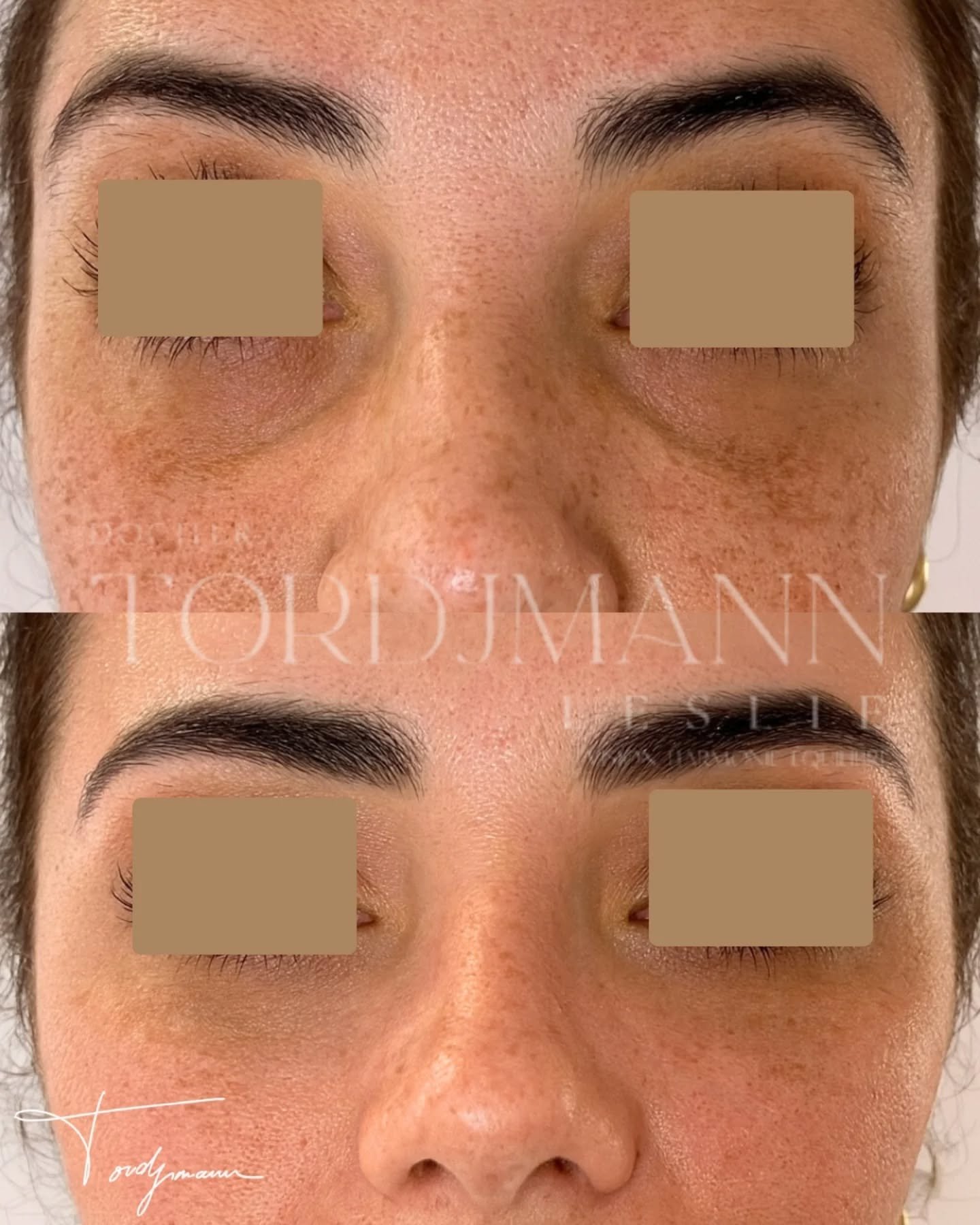 Traiter les cernes, ce n’est pas seulement combler un creux.
Les cernes creux sont souvent liés à une perte de soutien au niveau de la vallée des larmes et de la zone malaire.
Les injections d’acide hyaluronique des cernes permettent de restaurer ce soutien en profondeur, à condition de respecter l’anatomie et les indications.
Le produit est injecté de manière précise pour lisser la transition entre la paupière et la joue, sans alourdir le regard ni créer d’effet gonflé.
Dans certains cas, le traitement ne se limite pas au cerne lui-même mais inclut une approche globale du tiers moyen du visage.
Disclaimer – résultat illustré
Ces images présentent le résultat obtenu chez une patiente spécifique. Ce résultat ne garantit pas un résultat identique chez d’autres patients, chaque indication dépend de l’anatomie, de la qualité de peau et de la cause du cerne.
#acidehyaluronique
#valleedeslarmes
#regardfatigue
#cernes