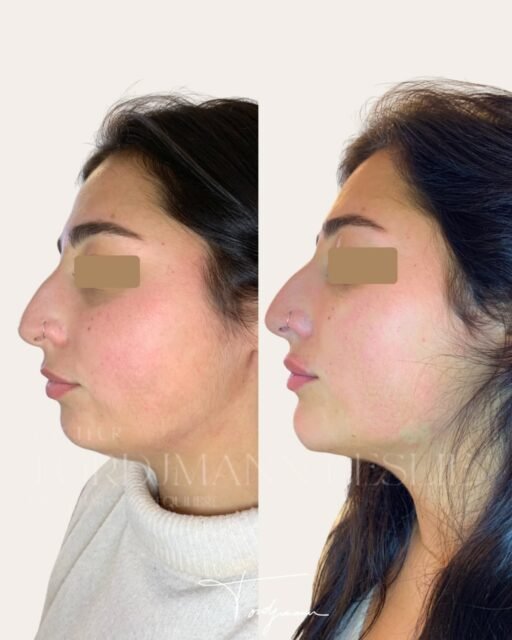Profiloplastie selon la méthode IDENTITY™

Dans cette profiloplastie selon la méthode IDENTITY™, l’objectif n’était pas de transformer ce visage, mais de rééquilibrer les proportions du profil tout en respectant son identité faciale et ses caractéristiques anthropométriques naturelles.

Chez cette patiente, l’analyse montrait principalement :
• un menton légèrement rétroprojeté
• une ligne cervico-mentonnière peu définie
• un nez avec une légère dominance visuelle sur le profil liée au manque de projection du tiers inférieur du visage.

Le point important, c’est que le nez n’était pas réellement “trop grand”.

Le déséquilibre venait surtout du rapport entre le nez, les lèvres et le menton.
Dans cette situation, la méthode IDENTITY™ consiste à analyser les proportions globales plutôt qu’à traiter une zone isolée.

Ici, les injections ont principalement été réalisées :
• au niveau du menton pour améliorer la projection et soutenir le tiers inférieur
• le long de la ligne mandibulaire pour redéfinir l’angle du profil

L’objectif n’était pas d’obtenir un nez “instagram” très relevé ou artificiellement creusé.
Chez cette patiente présentant une anthropométrie faciale européenne méditerranéenne, conserver une ligne nasale douce et naturelle était essentiel pour préserver l’harmonie ethnique du visage et éviter une standardisation excessive des traits.

Le fait de projeter le menton a permis de rééquilibrer l’ensemble du profil et de rendre le nez visuellement plus harmonieux sans chirurgie.

C’est exactement la logique de la méthode IDENTITY™ :
traiter les rapports entre les structures plutôt qu’ajouter simplement du volume.

⚠️ Les résultats présentés sont spécifiques à cette patiente et dépendent de l’anatomie, des tissus, de l’anthropométrie faciale, du vieillissement et des indications de chacun. Ce résultat ne garantit pas un résultat identique chez une autre personne.