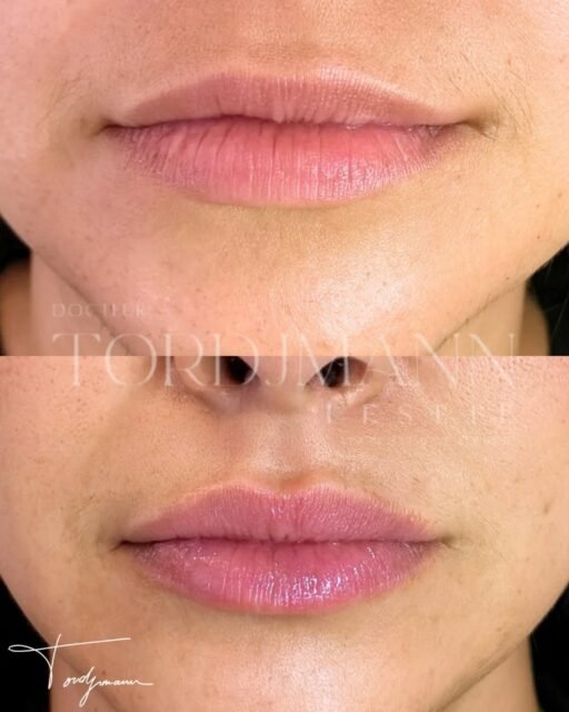 Des lèvres harmonisées sans perdre leur naturel.

Les injections d’acide hyaluronique lèvres ne consistent pas uniquement à augmenter le volume.
Le travail repose surtout sur l’équilibre des proportions, la définition du contour et l’hydratation des tissus.
Ici, l’objectif était de restaurer une bouche plus dessinée et plus lumineuse, tout en conservant une intégration naturelle au visage.

Le produit est injecté de manière progressive et précise afin d’éviter un aspect figé ou surcorrigé.

Ce résultat montre une amélioration de la définition et de la projection des lèvres avec un rendu souple, équilibré et naturel.

Une injection bien réalisée doit harmoniser les lèvres sans transformer l’expression du visage.

Disclaimer – résultat illustré
Ces images présentent le résultat obtenu chez une patiente spécifique.
Ce résultat ne garantit pas un résultat identique chez d’autres patients, chaque indication dépend de l’anatomie, des proportions naturelles et des objectifs individuels.

#acidehyaluronique
#levres
#russianlips
#harmonisationfaciale
#medecineesthetique