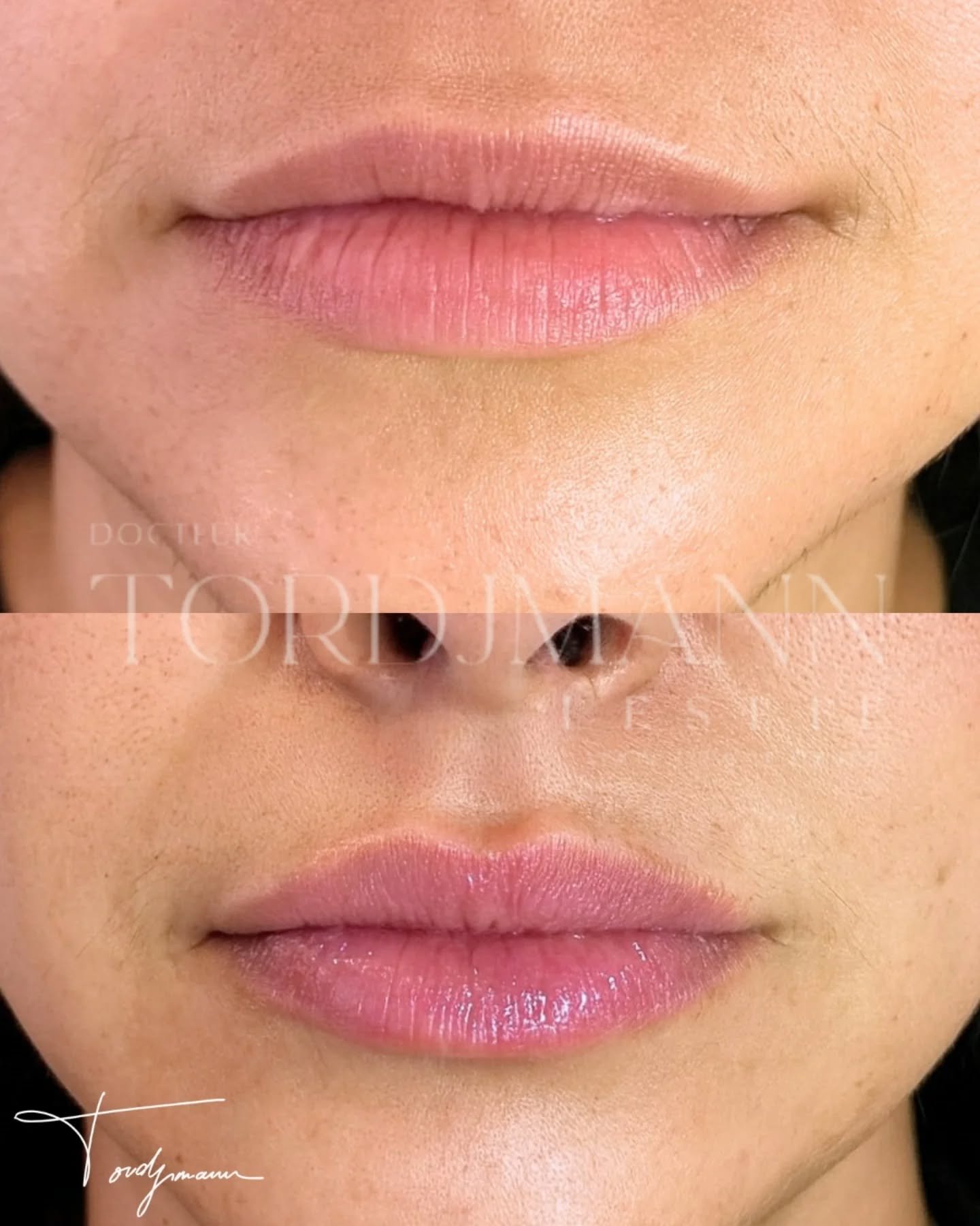Des lèvres harmonisées sans perdre leur naturel.

Les injections d’acide hyaluronique lèvres ne consistent pas uniquement à augmenter le volume.
Le travail repose surtout sur l’équilibre des proportions, la définition du contour et l’hydratation des tissus.
Ici, l’objectif était de restaurer une bouche plus dessinée et plus lumineuse, tout en conservant une intégration naturelle au visage.

Le produit est injecté de manière progressive et précise afin d’éviter un aspect figé ou surcorrigé.

Ce résultat montre une amélioration de la définition et de la projection des lèvres avec un rendu souple, équilibré et naturel.

Une injection bien réalisée doit harmoniser les lèvres sans transformer l’expression du visage.

Disclaimer – résultat illustré
Ces images présentent le résultat obtenu chez une patiente spécifique.
Ce résultat ne garantit pas un résultat identique chez d’autres patients, chaque indication dépend de l’anatomie, des proportions naturelles et des objectifs individuels.

#acidehyaluronique
#levres
#russianlips
#harmonisationfaciale
#medecineesthetique