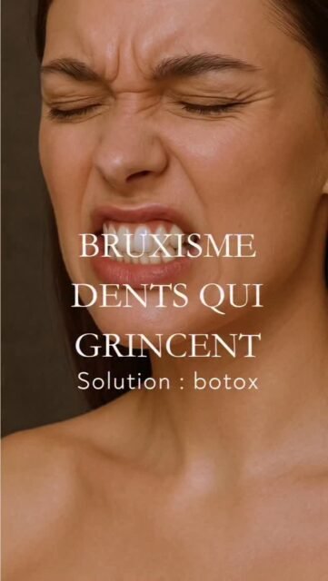 Vous grincez des dents la nuit ?
Vous avez des douleurs au niveau de la mâchoire, des tensions ou des maux de tête au réveil ?

Une des solutions possibles, c’est le Botox au niveau des masséters.

Le bruxisme est souvent lié à une hyperactivité des muscles de la mastication, principalement le muscle masséter ici, au niveau de l’angle de la mâchoire.

Avec le temps, ce muscle peut devenir hypertrophié, c’est-à-dire plus volumineux et plus puissant.
Et ça peut entraîner :
• des douleurs de mâchoire
• des tensions cervicales
• des migraines
• une usure des dents
• ou même un visage qui paraît plus carré.

Le Botox agit comme un relaxant musculaire.
Quand on l’injecte dans le masséter, ça permet de diminuer progressivement la force de contraction du muscle.

Résultat :
• moins de serrage
• moins de tensions
• parfois moins de migraines
• et chez certaines personnes, une mâchoire qui s’affine progressivement.

Chez certains patients, notamment ceux qui ont des douleurs temporales ou des migraines associées, on peut aussi traiter le muscle temporal au niveau des tempes.

Pourquoi ?
Parce que ces muscles fonctionnent ensemble dans la mastication et peuvent participer au même schéma de tension musculaire.

Le Botox ne remplace pas toujours une gouttière ou une prise en charge globale du bruxisme, mais ça peut être une très bonne option chez les personnes qui restent symptomatiques malgré les traitements habituels.

⚠️ Les injections de toxine botulique pour le bruxisme nécessitent une analyse précise de la dynamique musculaire et de l’occlusion. Tous les patients ne relèvent pas du même protocole de traitement.

#Bruxisme #BotoxMasseter #Jawline #Migraine
