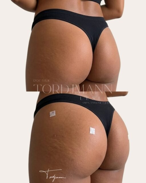 Remodelage des fesses par acide hyaluronique

Ici, l’objectif n’était pas simplement “d’augmenter” les fesses.
Le travail a surtout porté sur la projection, la transition hanche-fesse et l’amélioration des proportions globales de la silhouette.

Avec les injections d’acide hyaluronique corporel, on peut :
• augmenter légèrement le volume
• améliorer la rondeur
• corriger certaines asymétries
• créer davantage de projection
• améliorer certaines transitions anatomiques.

Contrairement aux idées reçues, ce type de traitement ne consiste pas à injecter massivement du produit partout.
Le résultat dépend surtout du placement stratégique des volumes.

Dans ce cas précis, les injections ont été réalisées principalement sur les zones latérales et supéro-externes afin de créer une courbe plus harmonieuse et une meilleure projection sans alourdir la silhouette.

L’intérêt de l’acide hyaluronique corporel est aussi de pouvoir travailler de façon relativement progressive et modulable selon l’anatomie, la qualité des tissus et le résultat recherché.

Ce type de traitement ne remplace pas un lifting chirurgical ou un lipofilling dans les relâchements importants, mais il peut être une très bonne option chez certains patients souhaitant un résultat plus subtil, sans chirurgie.

⚠️ Les résultats présentés sont spécifiques à cette patiente et dépendent notamment de l’anatomie, de la qualité cutanée, des volumes initiaux, du mode de vie et du métabolisme de chacun. Ce résultat ne garantit pas un résultat identique chez une autre personne.

#bodycontouring #Fesses #RemodelageFessier #BBL #BBLliquide