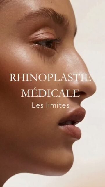 Trois raisons pour lesquelles vous ne pouvez PAS faire de rhinoplastie médicale.
La première :
si vous avez une cloison nasale très déviée.
La rhinoplastie médicale permet de corriger certaines irrégularités esthétiques du nez.
Mais elle ne permet pas de redresser une vraie déviation de cloison.
Si le problème est structurel ou fonctionnel, avec parfois une gêne respiratoire associée, dans ce cas-là il faut aller vers une rhinoplastie chirurgicale.
Deuxième situation :
une bosse trop importante.
Une petite bosse, oui, on peut parfois la camoufler avec de l’acide hyaluronique pour recréer une ligne plus harmonieuse.
Mais une grosse bosse… non.
Pourquoi ?
Parce qu’en injectant au-dessus et en dessous pour “aligner” le profil, on finit par créer un nez très massif, parfois totalement droit du front jusqu’à la pointe.
Et souvent, le résultat paraît peu naturel.
Dans ces cas-là, il vaut mieux être honnête :
la chirurgie reste la meilleure option.
Troisième situation :
un nez trop large.
La rhinoplastie médicale ne permet pas d’affiner réellement un nez.
Elle ne réduit ni les os, ni les cartilages, ni la largeur anatomique de la structure nasale.
Elle peut améliorer :
• certaines asymétries
• une petite bosse
• une pointe légèrement tombante
• un défaut de profil.
Mais elle ne peut pas transformer un nez large en nez fin.
C’est important de comprendre que la rhinoplastie médicale est un outil d’harmonisation, pas une alternative complète à la chirurgie.
⚠️ Toutes les indications de rhinoplastie médicale nécessitent une analyse anatomique précise du nez, du profil et des proportions du visage. Certaines morphologies relèvent davantage d’une prise en charge chirurgicale pour obtenir un résultat harmonieux et naturel.
#RhinoplastieMédicale #Nez #AcideHyaluronique #Profiloplastie #MédecineEsthétique