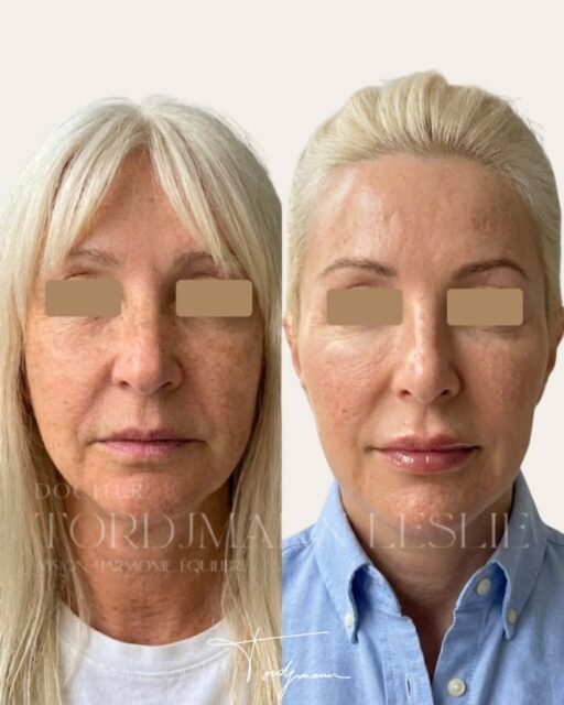 Cas complexe d’harmonisation faciale et rajeunissement selon la méthode IDENTITY™

Dans cette prise en charge selon la méthode IDENTITY™, l’objectif n’était pas de transformer le visage ni de le “gonfler”, mais de corriger les mécanismes du vieillissement tout en respectant l’identité faciale de la patiente.

Avec le temps, plusieurs phénomènes se produisent simultanément :
• perte de collagène
• relâchement des tissus
• fonte graisseuse
• modification des proportions du visage
• perte de qualité cutanée et d’éclat.

Ici, l’analyse anthropométrique et tissulaire montrait principalement :
• une perte de soutien du tiers moyen
• un relâchement du bas du visage
• une perte de définition de l’ovale
• une altération importante de la qualité de peau
• des ridules et une perte de densité cutanée.

La prise en charge a donc été pensée de façon globale et progressive avec plusieurs approches complémentaires :

• des biostimulateurs pour stimuler la production naturelle de collagène et remettre les tissus en tension
• de l’acide hyaluronique de soutien pour restaurer certaines structures sans surcharger les volumes
• des skinboosters pour améliorer l’hydratation profonde et la qualité cutanée
• un peeling TCA afin de travailler la texture, les irrégularités pigmentaires et l’éclat de peau.

Le but n’était pas d’effacer totalement tous les signes du vieillissement.
L’objectif était de retrouver une version plus reposée, plus fraîche et plus harmonieuse du visage… sans perdre l’expression ni l’identité initiale.

Dans la méthode IDENTITY™, le rajeunissement repose surtout sur l’équilibre des proportions, la qualité des tissus et la cohérence anatomique du visage plutôt que sur une simple augmentation des volumes.

⚠️ Les résultats présentés sont spécifiques à cette patiente et dépendent notamment de l’anatomie, de la qualité cutanée, du vieillissement, du mode de vie et des capacités de stimulation collagénique propres à chacun. Ce résultat ne garantit pas un résultat identique chez une autre personne.

#Rajeunissement #HarmonisationFaciale #Biostimulateur #AcideHyaluronique #methodeidentity