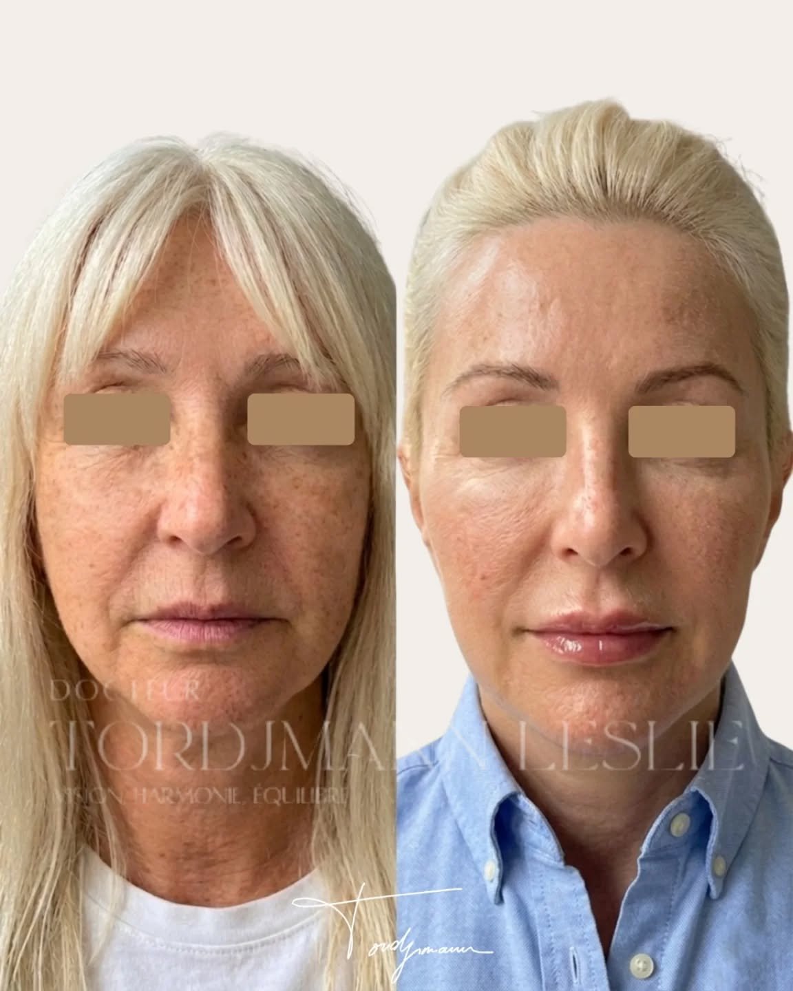 Cas complexe d’harmonisation faciale et rajeunissement selon la méthode IDENTITY™

Dans cette prise en charge selon la méthode IDENTITY™, l’objectif n’était pas de transformer le visage ni de le “gonfler”, mais de corriger les mécanismes du vieillissement tout en respectant l’identité faciale de la patiente.

Avec le temps, plusieurs phénomènes se produisent simultanément :
• perte de collagène
• relâchement des tissus
• fonte graisseuse
• modification des proportions du visage
• perte de qualité cutanée et d’éclat.

Ici, l’analyse anthropométrique et tissulaire montrait principalement :
• une perte de soutien du tiers moyen
• un relâchement du bas du visage
• une perte de définition de l’ovale
• une altération importante de la qualité de peau
• des ridules et une perte de densité cutanée.

La prise en charge a donc été pensée de façon globale et progressive avec plusieurs approches complémentaires :

• des biostimulateurs pour stimuler la production naturelle de collagène et remettre les tissus en tension
• de l’acide hyaluronique de soutien pour restaurer certaines structures sans surcharger les volumes
• des skinboosters pour améliorer l’hydratation profonde et la qualité cutanée
• un peeling TCA afin de travailler la texture, les irrégularités pigmentaires et l’éclat de peau.

Le but n’était pas d’effacer totalement tous les signes du vieillissement.
L’objectif était de retrouver une version plus reposée, plus fraîche et plus harmonieuse du visage… sans perdre l’expression ni l’identité initiale.

Dans la méthode IDENTITY™, le rajeunissement repose surtout sur l’équilibre des proportions, la qualité des tissus et la cohérence anatomique du visage plutôt que sur une simple augmentation des volumes.

⚠️ Les résultats présentés sont spécifiques à cette patiente et dépendent notamment de l’anatomie, de la qualité cutanée, du vieillissement, du mode de vie et des capacités de stimulation collagénique propres à chacun. Ce résultat ne garantit pas un résultat identique chez une autre personne.

#Rajeunissement #HarmonisationFaciale #Biostimulateur #AcideHyaluronique #methodeidentity