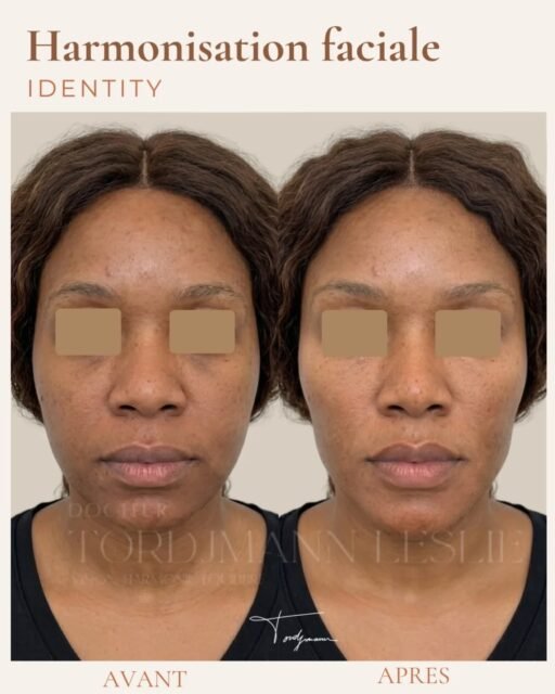 ✨ Harmonisation faciale – Méthode IDENTITY™
Chaque visage possède ses propres équilibres, ses proportions et son identité.
L’objectif de cette prise en charge n’était pas de transformer ce visage, mais de restaurer certaines structures, améliorer les proportions et apporter davantage d’harmonie tout en respectant les caractéristiques naturelles de la patiente.
Grâce à une analyse globale du visage selon la méthode IDENTITY™, le protocole a été personnalisé afin de corriger les déséquilibres sans standardiser les traits.
Le résultat : un visage plus reposé, plus harmonieux et plus lumineux, tout en restant parfaitement reconnaissable.
Parce qu’en médecine esthétique, le plus beau résultat est souvent celui que l’on remarque sans pouvoir l’expliquer.
⚠️ Disclaimer : Les photographies présentées illustrent le résultat obtenu chez une patiente spécifique après une prise en charge personnalisée. Les résultats varient selon l’anatomie, la qualité de peau, les volumes initiaux, le vieillissement tissulaire et les traitements réalisés. Aucun résultat identique ne peut être garanti.
#HarmonisationFaciale #MéthodeIDENTITY #MédecineEsthétique #RajeunissementNaturel #AcideHyaluronique