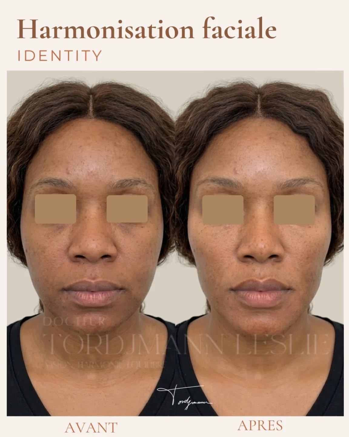 ✨ Harmonisation faciale – Méthode IDENTITY™
Chaque visage possède ses propres équilibres, ses proportions et son identité.
L’objectif de cette prise en charge n’était pas de transformer ce visage, mais de restaurer certaines structures, améliorer les proportions et apporter davantage d’harmonie tout en respectant les caractéristiques naturelles de la patiente.
Grâce à une analyse globale du visage selon la méthode IDENTITY™, le protocole a été personnalisé afin de corriger les déséquilibres sans standardiser les traits.
Le résultat : un visage plus reposé, plus harmonieux et plus lumineux, tout en restant parfaitement reconnaissable.
Parce qu’en médecine esthétique, le plus beau résultat est souvent celui que l’on remarque sans pouvoir l’expliquer.
⚠️ Disclaimer : Les photographies présentées illustrent le résultat obtenu chez une patiente spécifique après une prise en charge personnalisée. Les résultats varient selon l’anatomie, la qualité de peau, les volumes initiaux, le vieillissement tissulaire et les traitements réalisés. Aucun résultat identique ne peut être garanti.
#HarmonisationFaciale #MéthodeIDENTITY #MédecineEsthétique #RajeunissementNaturel #AcideHyaluronique