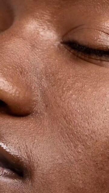 ✨ Mésobotox (Micro-Botox)
Le Botox ne sert pas uniquement à traiter les rides du front.
Injecté en micro-doses très superficielles dans la peau, le Mésobotox permet d’améliorer la qualité cutanée sans figer les expressions.
Cette technique agit sur les micro-contractions musculaires, diminue la production de sébum, resserre visuellement les pores et apporte un effet peau plus lisse et plus lumineuse.
Le résultat recherché n’est pas un changement des traits, mais une peau plus fraîche, plus homogène et plus reposée.
Particulièrement apprécié pour les peaux mixtes à grasses, les pores dilatés ou les ridules diffuses, le Mésobotox peut être intégré dans une stratégie globale de rajeunissement et d'amélioration de la qualité de peau.
Parce qu'en médecine esthétique, une belle peau est souvent ce qui fait la différence avant même les volumes.
#Mesobotox #MicroBotox #QualitéDePeau #medecineesthétique