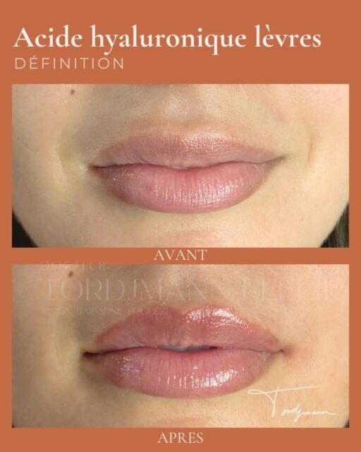 ✨ Des lèvres plus définies sans perdre leur naturel.
L’objectif des injections d’acide hyaluronique des lèvres n’est pas forcément d’obtenir des lèvres très volumineuses. Dans de nombreux cas, il s’agit surtout de restaurer l’hydratation, redessiner le contour, améliorer la projection et rééquilibrer les proportions entre la lèvre supérieure et inférieure.
Sur cet exemple, le résultat reste harmonieux avec le visage : les lèvres paraissent plus pulpeuses, mieux dessinées et plus lumineuses, tout en conservant un aspect naturel.
L’acide hyaluronique permet d’adapter le résultat à chaque morphologie : augmentation discrète du volume, correction d’asymétrie, définition de l’arc de Cupidon ou amélioration de l’hydratation des lèvres.
L’objectif n’est pas de transformer, mais d’harmoniser.
⚠️ Disclaimer : Les résultats présentés sont spécifiques à cette patiente. Chaque visage possède une anatomie, des proportions et des besoins différents. Un traitement personnalisé est indispensable pour obtenir un résultat harmonieux et adapté. Les résultats peuvent varier d'une personne à l'autre. Les actes médicaux comportent des indications, contre-indications, risques et effets secondaires qui sont systématiquement abordés lors de la consultation médicale préalable.
#AcideHyaluroniqueLèvres #InjectionLèvres #RussianLips #LipFiller #MédecineEsthétique