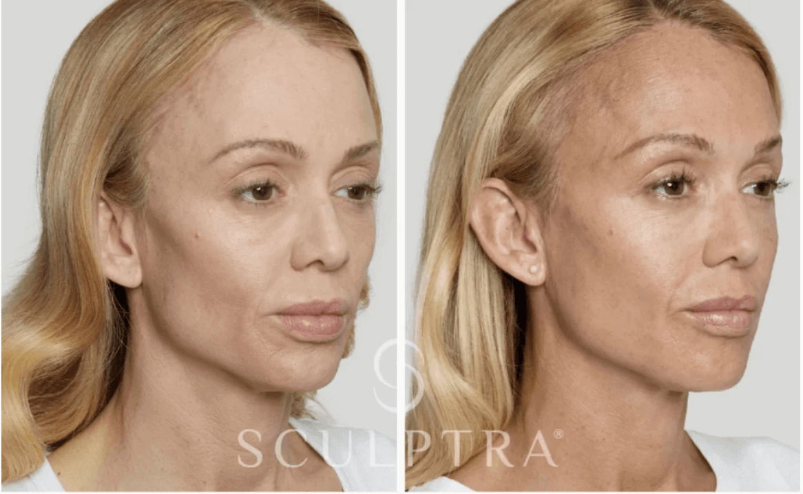 Sculptra Avant/Après