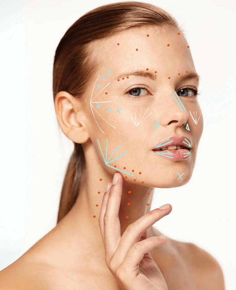 Schéma harmonisation faciale injections