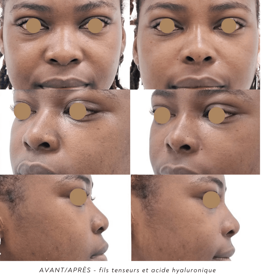 Avant/Après Rhinoplastie - Fils tenseurs et acide hyaluronique