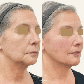 Avant_Après fils tenseurs ovale du visage effet lifting - femme agée