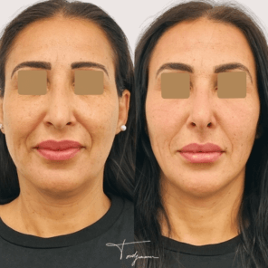 Avant_Après fils tenseurs ovale du visage effet lifting - femme jeune