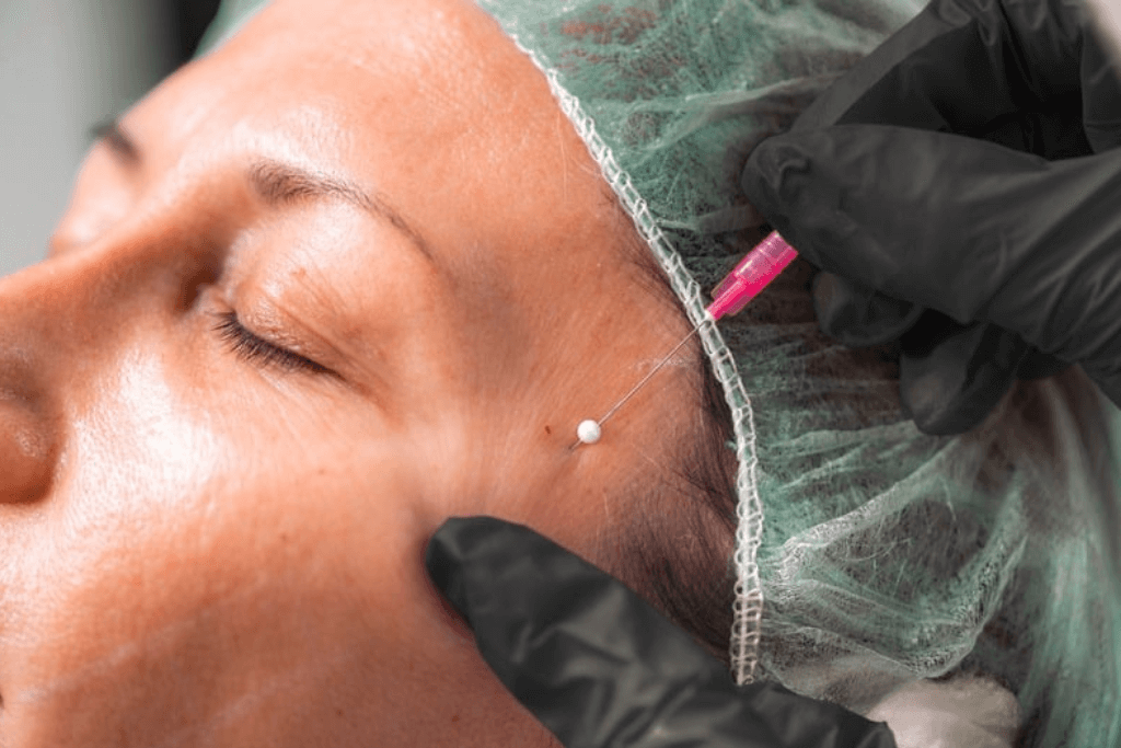 Fils tenseurs - visage femme