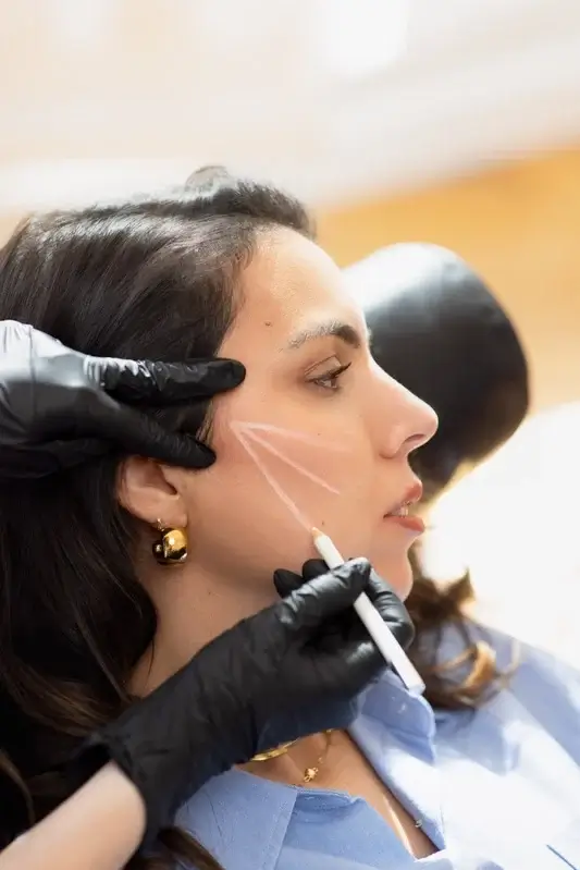 Médecin esthétique pose fils tenseurs bas du visage - femme