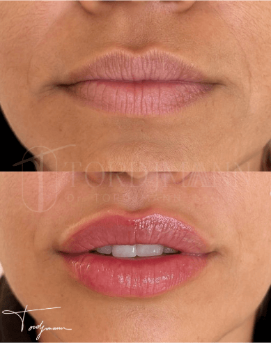 Injection d’acide hyaluronique pour un effet naturel sur les lèvres : avant/après réalisé en cabinet esthétique près de Paris
