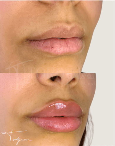 Correction naturelle des lèvres par injection d’acide hyaluronique : hydratation et subtil volume, résultat avant/après, Paris